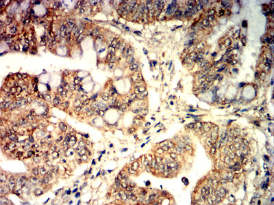 Figure 9:Immunohistochemical analysis of paraffin-embedded rectal cancer tissues using TNFSF9 mouse mAb with DAB staining.