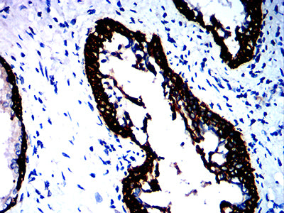 Figure 8:Immunohistochemical analysis of paraffin-embedded prostate cancer tissues using KRT15 mouse mAb with DAB staining.