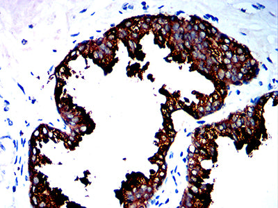Figure 6:Immunohistochemical analysis of paraffin-embedded prostate cancer tissues using SIGLEC8 mouse mAb with DAB staining.