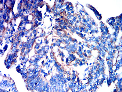 Figure 6:Immunohistochemical analysis of paraffin-embedded rectum cancer tissues using FPR3 mouse mAb with DAB staining.