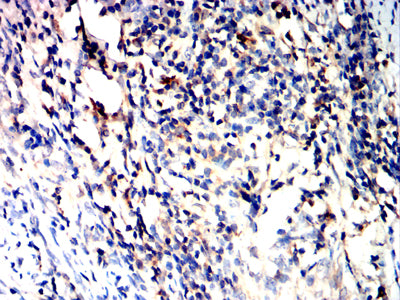 Figure 5:Immunohistochemical analysis of paraffin-embedded cervical cancer tissues using TLR10 mouse mAb with DAB staining.