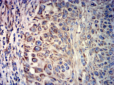 Figure 6:Immunohistochemical analysis of paraffin-embedded lung cancer tissues using ATP5F1A mouse mAb with DAB staining.