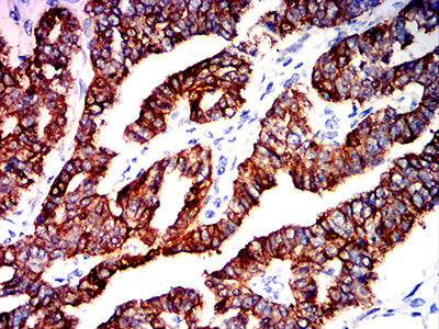 Figure 6:Immunohistochemical analysis of paraffin-embedded ovarian cancer tissues using KRT2 mouse mAb with DAB staining.