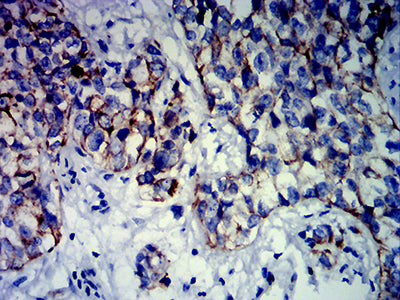 Figure 6:Immunohistochemical analysis of paraffin-embedded bladder cancer tissues using KRT13 mouse mAb with DAB staining.