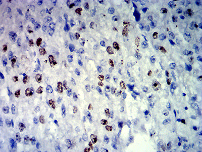 Figure 5:Immunohistochemical analysis of paraffin-embedded liver cancer tissues using MKI67 mouse mAb with DAB staining.