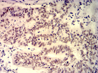 Figure 6:Immunohistochemical analysis of paraffin-embedded colon cancer tissues using PDLIM7 mouse mAb with DAB staining.
