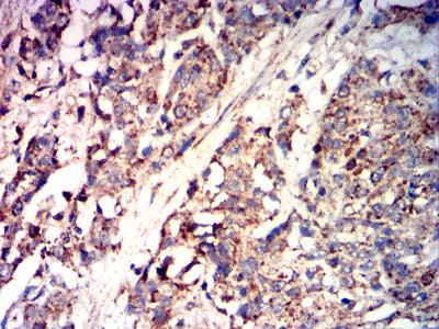 Figure 7:Immunohistochemical analysis of paraffin-embedded esophageal cancer tissues using CD85K mouse mAb with DAB staining.