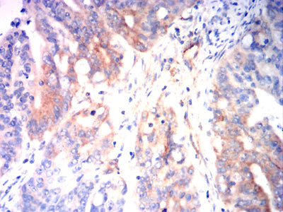 Figure 11:Immunohistochemical analysis of paraffin-embedded rectal cancer tissues using CD126 mouse mAb with DAB staining.