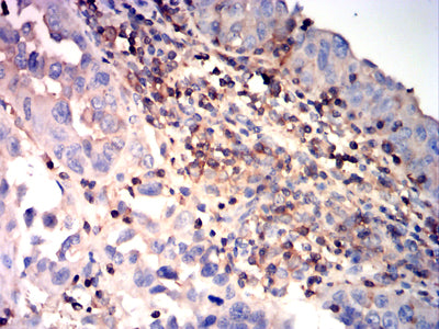 Figure 11:Immunohistochemical analysis of paraffin-embedded endometrial carcinoma tissues using RHOA mouse mAb with DAB staining.