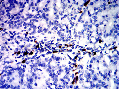 Figure 6:Immunohistochemical analysis of paraffin-embedded rectum cancer tissues using S100A9 mouse mAb with DAB staining.