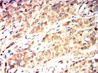 Figure 6:Immunohistochemical analysis of paraffin-embedded bladder Cancer tissues using HSP70 mouse mAb with DAB staining.