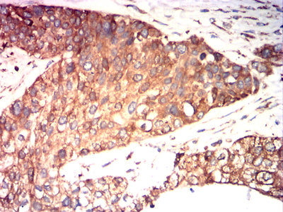 Figure 7:Immunohistochemical analysis of paraffin-embedded ovarian cancer tissues using P4HB mouse mAb with DAB staining.