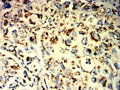 Figure 7:Immunohistochemical analysis of paraffin-embedded lung cancer tissues using UQCRC1 mouse mAb with DAB staining.