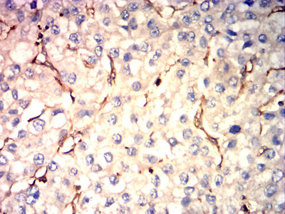 Figure 9:Immunohistochemical analysis of paraffin-embedded liver cancer tissues using VASP mouse mAb with DAB staining.