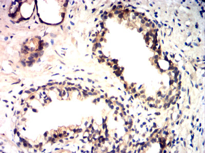 Figure 9:Immunohistochemical analysis of paraffin-embedded prostate cancer tissues using HSP70 mouse mAb with DAB staining.