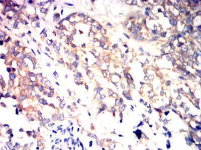 Figure 5:Immunohistochemical analysis of paraffin-embedded bladder cancer tissues using BRAF mouse mAb with DAB staining.