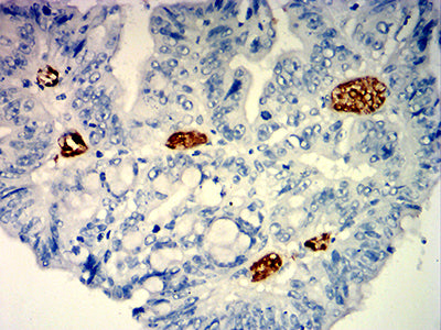 Figure 5:Immunohistochemical analysis of paraffin-embedded rectum cancer tissues using MUC12 mouse mAb with DAB staining.