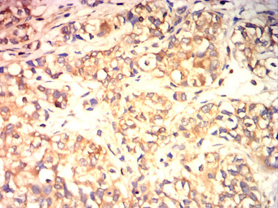 Figure 6: Immunohistochemical analysis of paraffin-embedded bladder cancer tissues using TUBA4A mouse mAb with DAB staining.