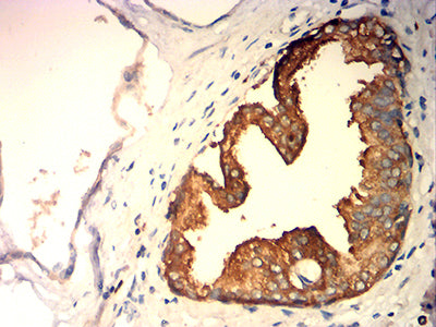 Figure 5:Immunohistochemical analysis of paraffin-embedded prostate cancer tissues using KLK2 mouse mAb with DAB staining.