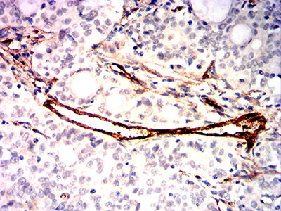 Figure 6:Immunohistochemical analysis of paraffin-embedded cervical cancer tissues using CD105 mouse mAb with DAB staining.