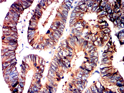 Figure 8:Immunohistochemical analysis of paraffin-embedded rectum cancer tissues using ATP1A1 mouse mAb with DAB staining.