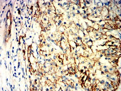 Figure 10:Immunohistochemical analysis of paraffin-embedded kidney cancer tissues using CDK4 mouse mAb with DAB staining.