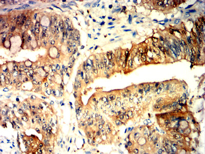 Figure 7:Immunohistochemical analysis of paraffin-embedded rectal cancer tissues using CD42A mouse mAb with DAB staining.