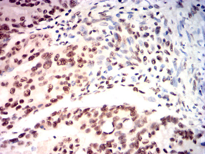 Figure 11:Immunohistochemical analysis of paraffin-embedded rectal cancer tissues using USP7 mouse mAb with DAB staining.