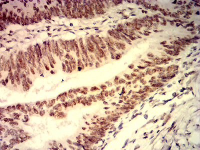 Figure 7:Immunohistochemical analysis of paraffin-embedded rectum cancer tissues using PDLIM7 mouse mAb with DAB staining.
