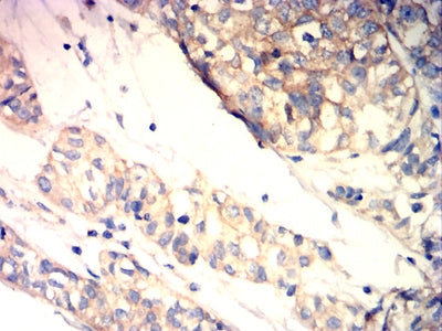 Figure 7:Immunohistochemical analysis of paraffin-embedded bladder cancer tissues using BRAF mouse mAb with DAB staining.