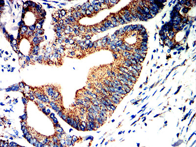 Figure 8:Immunohistochemical analysis of paraffin-embedded colon cancer tissues using UQCRC1 mouse mAb with DAB staining.