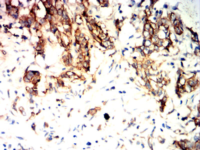 Figure 8:Immunohistochemical analysis of paraffin-embedded stomach cancer tissues using TSPAN8 mouse mAb with DAB staining.