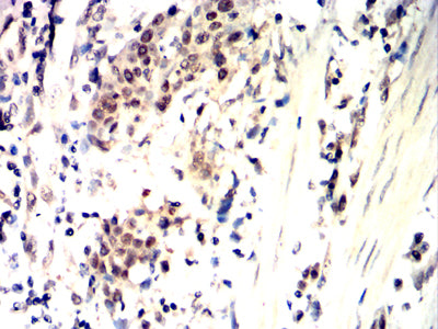 Figure 6:Immunohistochemical analysis of paraffin-embedded esophageal cancer tissues using CDK4 mouse mAb with DAB staining.