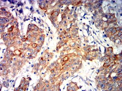 Figure 9:Immunohistochemical analysis of paraffin-embedded stomach cancer tissues using CDH1 mouse mAb with DAB staining.