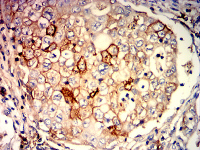 Figure 8:Immunohistochemical analysis of paraffin-embedded lung cancer tissues using TNFSF9 mouse mAb with DAB staining.