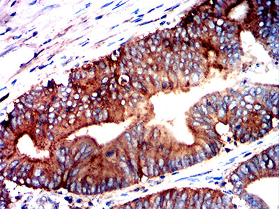 Figure 6:Immunohistochemical analysis of paraffin-embedded colon cancer tissues using CD317 mouse mAb with DAB staining.