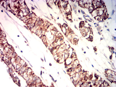 Figure 8:Immunohistochemical analysis of paraffin-embedded bladder cancer tissues using ETFA mouse mAb with DAB staining.