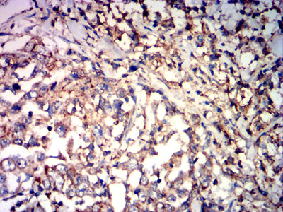 Figure 8:Immunohistochemical analysis of paraffin-embedded stomach cancer tissues using CD85K mouse mAb with DAB staining.