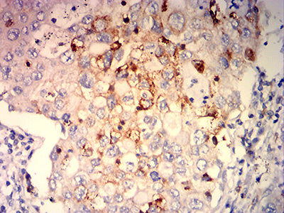 Figure 5:Immunohistochemical analysis of paraffin-embedded lung cancer tissues using ITGB7 mouse mAb with DAB staining.