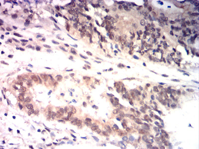 Figure 9:Immunohistochemical analysis of paraffin-embedded rectal cancer tissues using HSP70 mouse mAb with DAB staining.