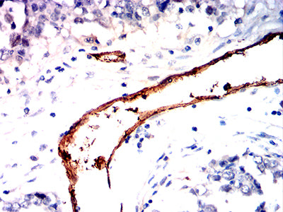 Figure 7:Immunohistochemical analysis of paraffin-embedded endometrial cancer tissues using CD105 mouse mAb with DAB staining.