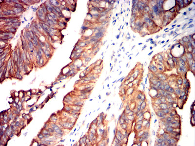 Figure 11:Immunohistochemical analysis of paraffin-embedded rectal cancer tissues using NDC80 mouse mAb with DAB staining.