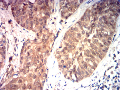 Figure 8:Immunohistochemical analysis of paraffin-embedded bladder cancer tissues using HSP70 mouse mAb with DAB staining.