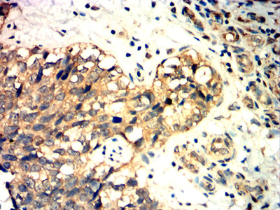 Figure 6:Immunohistochemical analysis of paraffin-embedded bladder cancer tissues using PODXL mouse mAb with DAB staining.