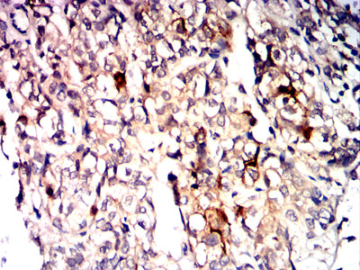 Figure 7:Immunohistochemical analysis of paraffin-embedded bladder cancer tissues using CD10 mouse mAb with DAB staining.