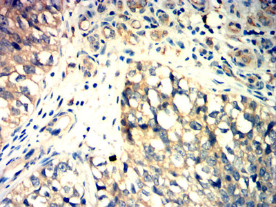 Figure 6:Immunohistochemical analysis of paraffin-embedded bladder cancer tissues using GPR56 mouse mAb with DAB staining.