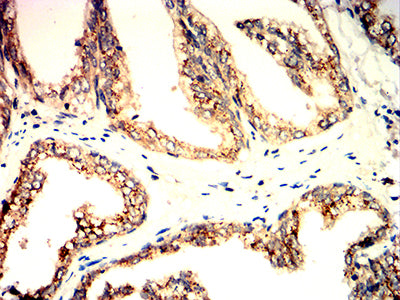 Figure 7:Immunohistochemical analysis of paraffin-embedded prostate cancer tissues using GOLGA2 mouse mAb with DAB staining.