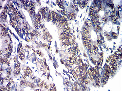 Figure 6: Immunohistochemical analysis of paraffin-embedded cervical cancer tissues using SOX11 mouse mAb with DAB staining.