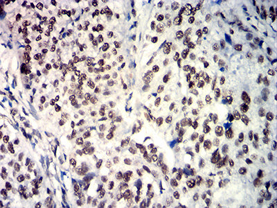 Figure 7: Immunohistochemical analysis of paraffin-embedded bladder cancer tissues using SOX11 mouse mAb with DAB staining.