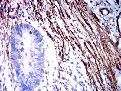 Figure 6: Immunohistochemical analysis of paraffin-embedded stomach cancer tissues using ACTA2 mouse mAb with DAB staining.